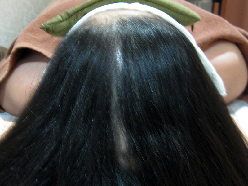 45歳 女性 発毛コース(6ヵ月)【40歳を越えて頭頂部の抜け毛が激しくなった】 After