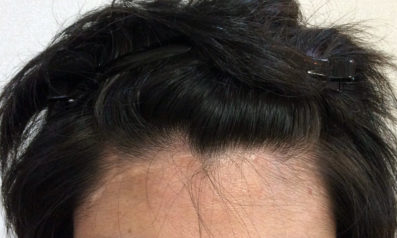 28歳 男性 発毛コース24回(6ヵ月)【M字の薄毛ハーグ療法で効果なし】 After