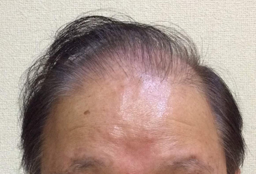 62歳 男性 発毛保証48回(12ヵ月)【壮年性脱毛症が気になり植毛を試したが発毛で良かった】 Befor