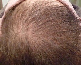 69歳 女性 発毛コース24回(4か月目)【白髪染めを繰り返すことで抜け毛が増えた】 Befor