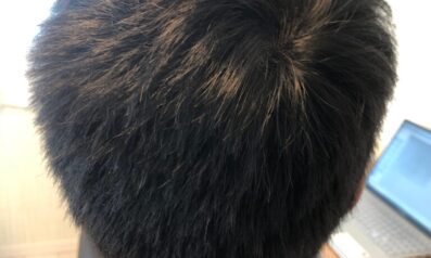 20代男性 発毛コース12回【11回目経過途中:頭頂部の髪の毛が太くなりました】 After