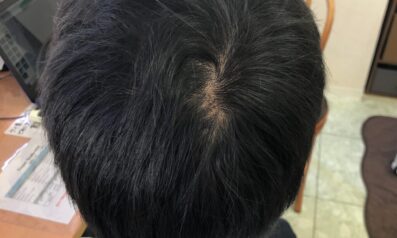 20代男性 発毛コース12回【11回目経過途中:頭頂部の髪の毛が太くなりました】 Befor